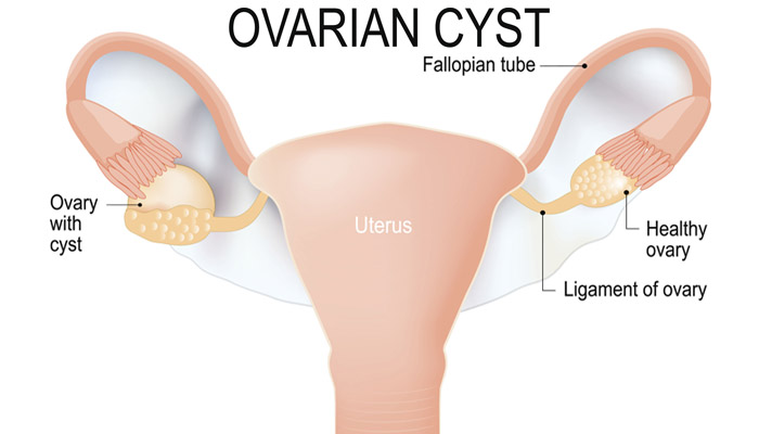 Ovarian Cysts During Pregnancy: Types, Symptoms & Treatments